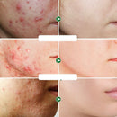 Creme Facial para Pele Oleosa e Cuidados com Acne | Davorah